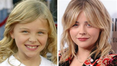 chloe grace moretz surgery.